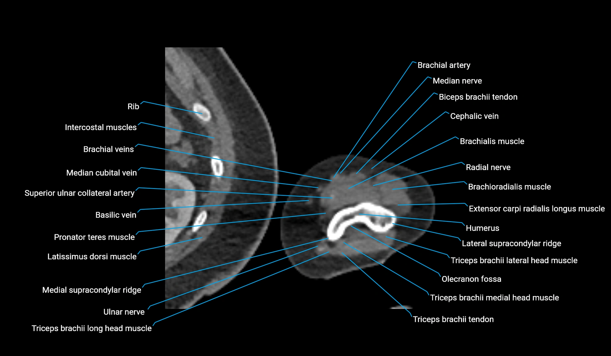 CT upper arm axial  cross sectional anatomy labelled radiology image -00368.webp